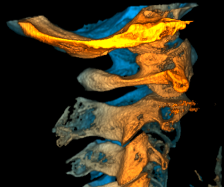 Spine Right 1